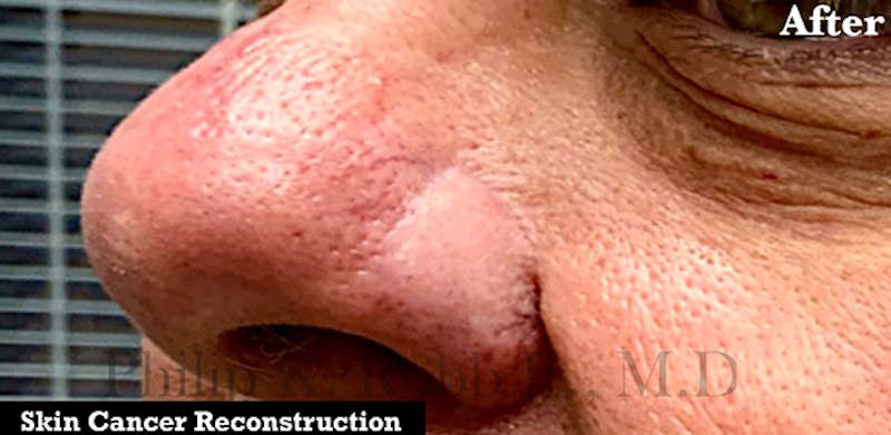 Nasal Reconstruction Before & After Gallery - Patient 427438 - Image 2