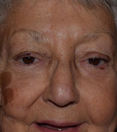 Nasal Reconstruction Before & After Gallery - Patient 220043 - Image 2