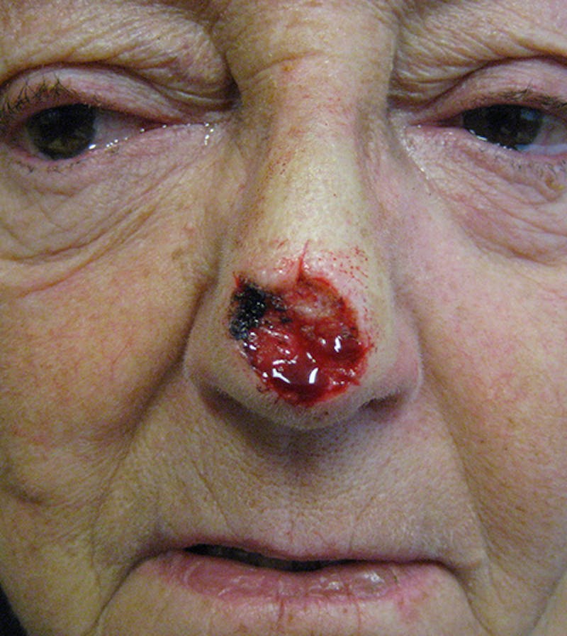 Nasal Reconstruction Before & After Gallery - Patient 220043 - Image 3