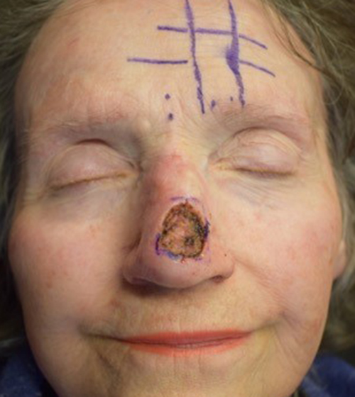 Patient 792487 | Nasal Reconstruction Before & After Photos | Robb