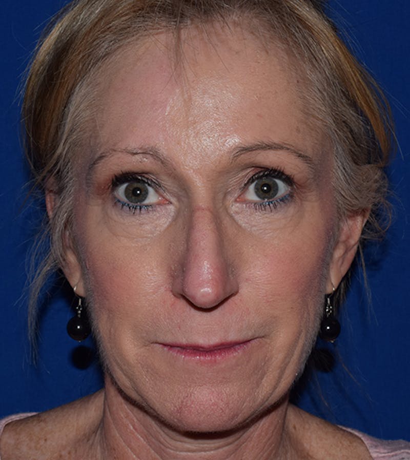 Nasal Reconstruction Before & After Gallery - Patient 193143 - Image 3