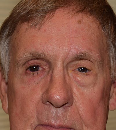 Nasal Reconstruction Before & After Gallery - Patient 914060 - Image 2