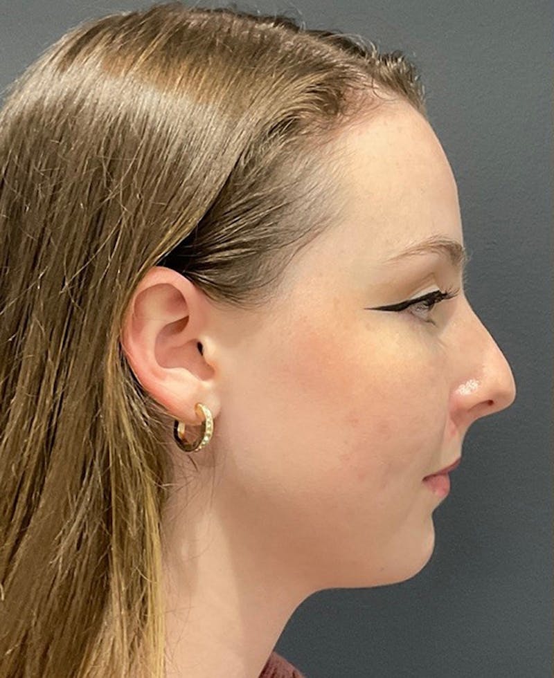 Ultrasonic Rhinoplasty Before & After Gallery - Patient 140456 - Image 1
