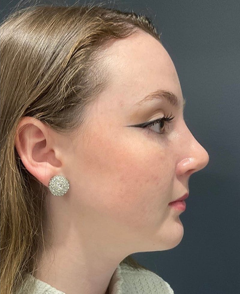 Ultrasonic Rhinoplasty Before & After Gallery - Patient 140456 - Image 2