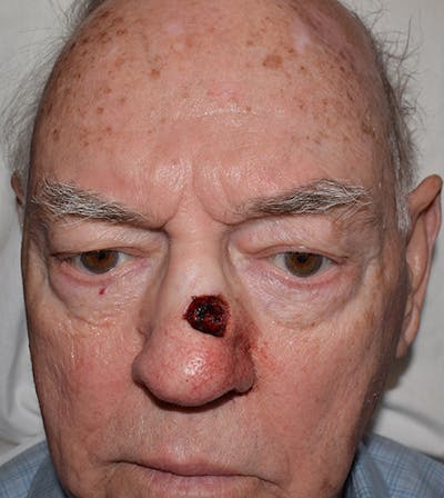 Nasal Reconstruction Before & After Gallery - Patient 260110 - Image 1