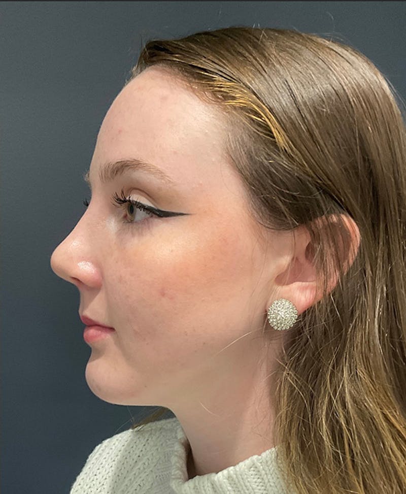 Ultrasonic Rhinoplasty Before & After Gallery - Patient 140456 - Image 6