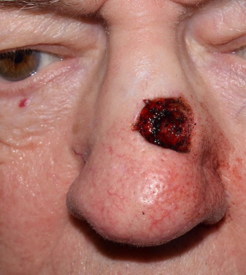 Nasal Reconstruction Before & After Gallery - Patient 260110 - Image 3