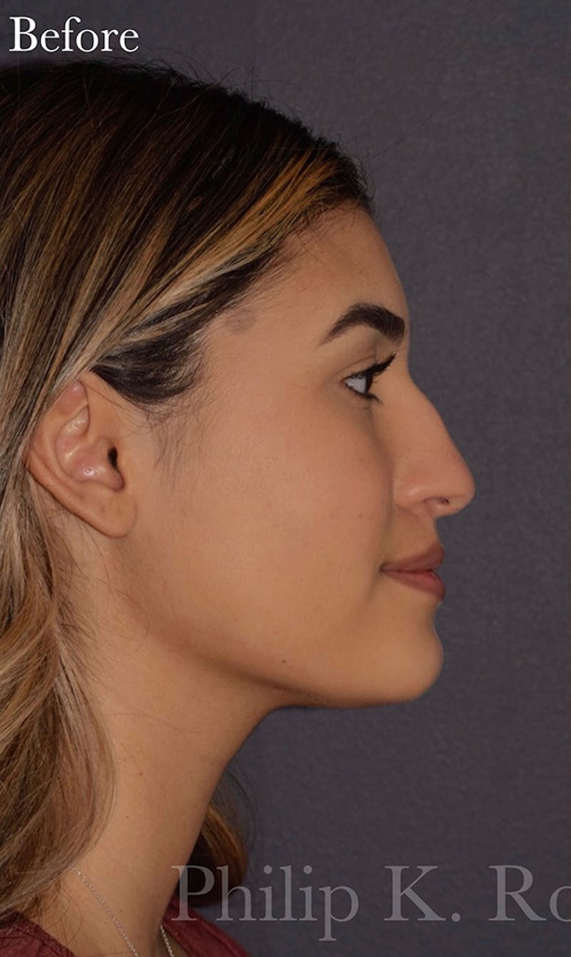 Ultrasonic Rhinoplasty Before & After Gallery - Patient 305976 - Image 1