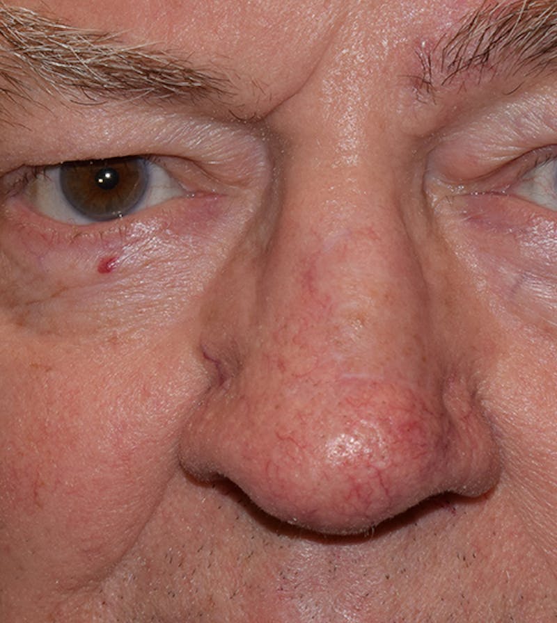 Nasal Reconstruction Before & After Gallery - Patient 260110 - Image 4