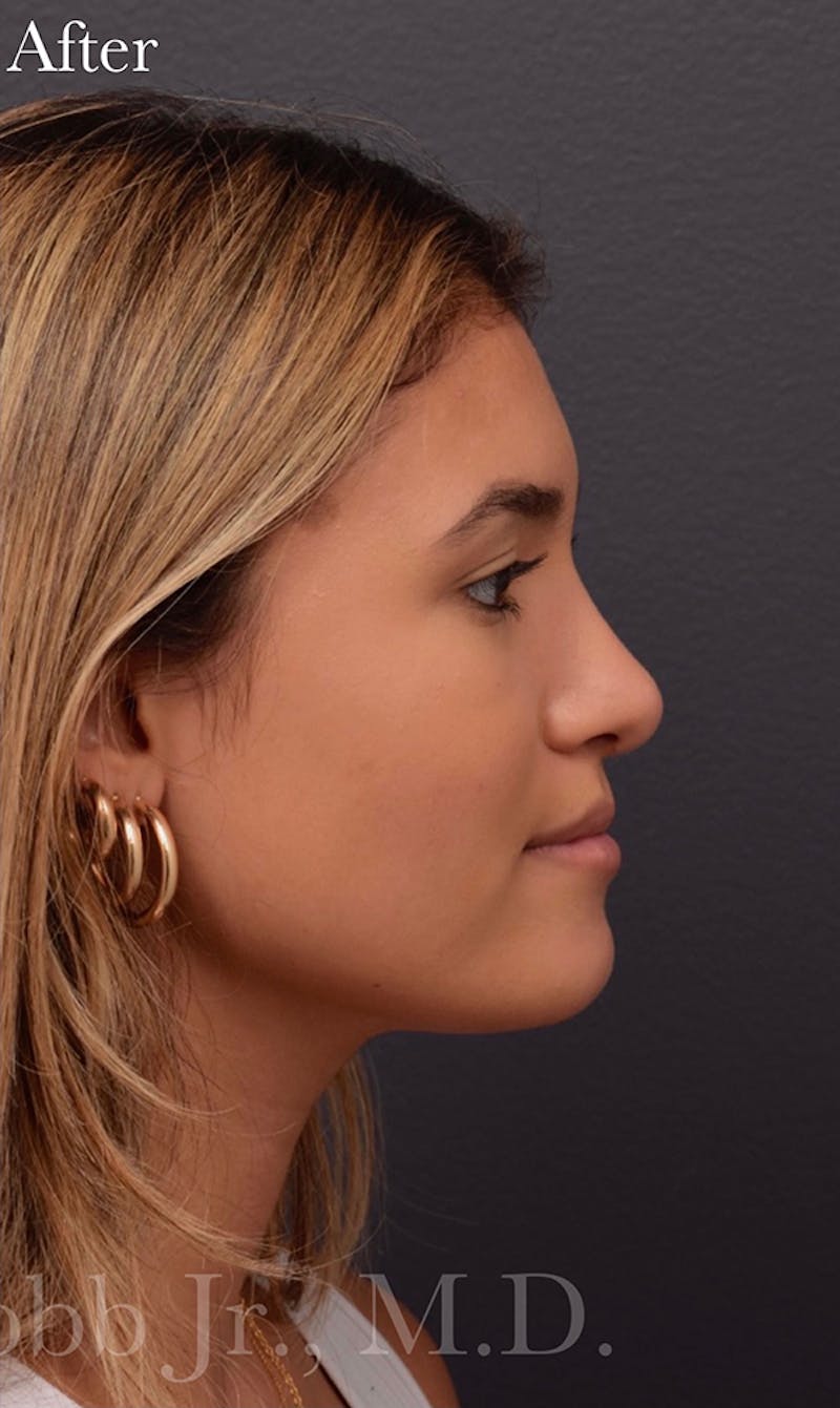 Ultrasonic Rhinoplasty Before & After Gallery - Patient 305976 - Image 2