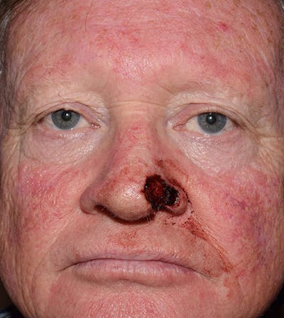 Nasal Reconstruction Before & After Gallery - Patient 125381 - Image 1