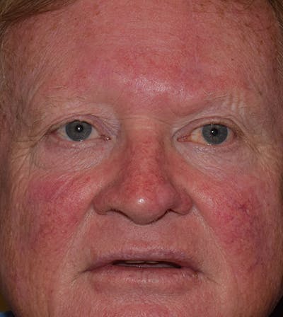 Nasal Reconstruction Before & After Gallery - Patient 125381 - Image 2