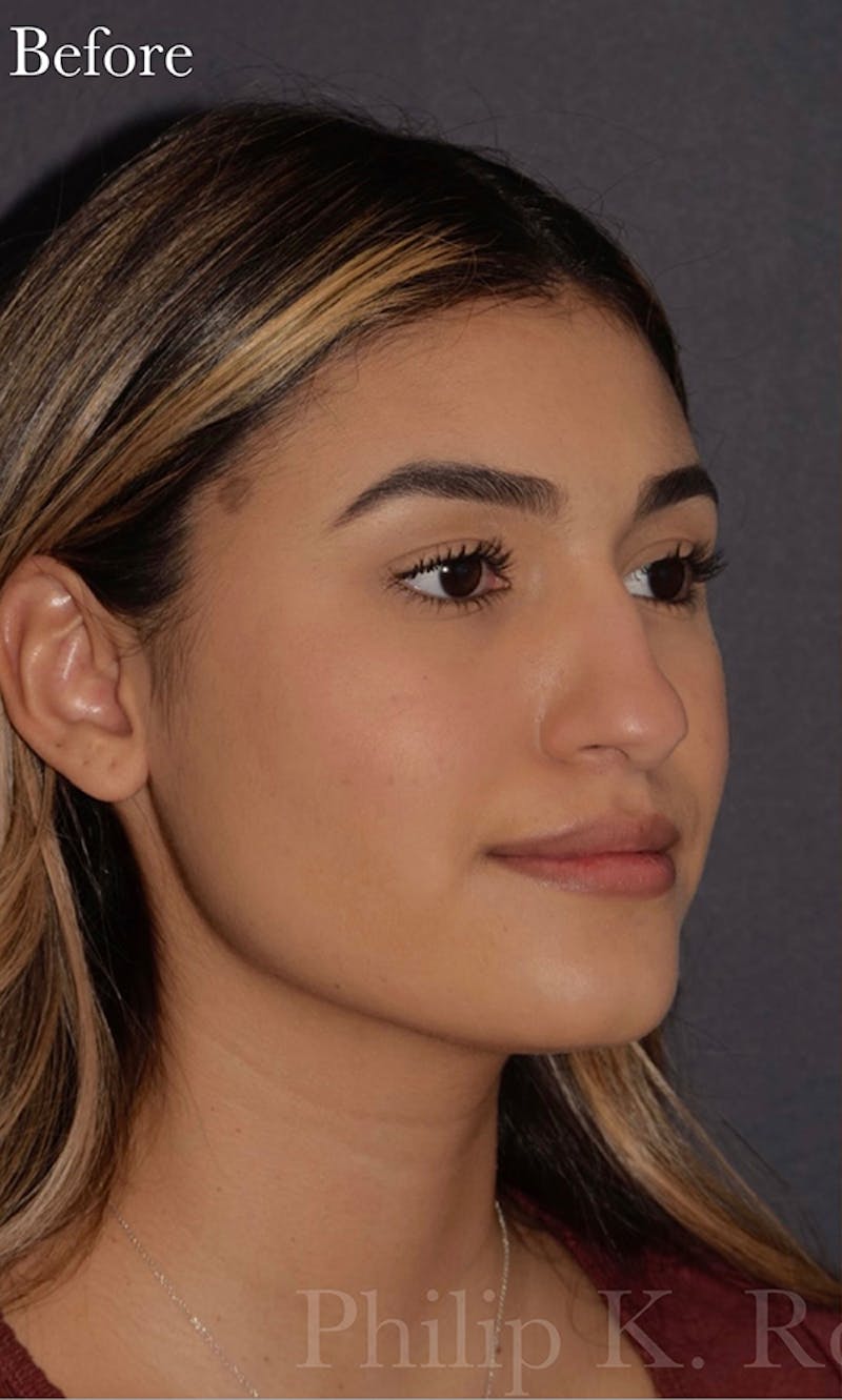 Ultrasonic Rhinoplasty Before & After Gallery - Patient 305976 - Image 5