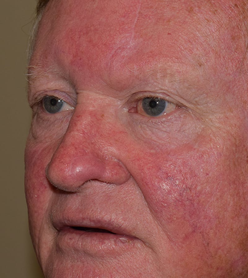 Nasal Reconstruction Before & After Gallery - Patient 125381 - Image 4