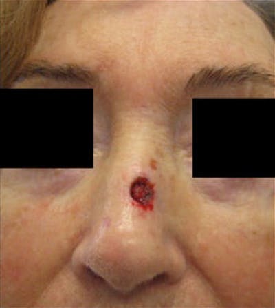Nasal Reconstruction Before & After Gallery - Patient 272422 - Image 1