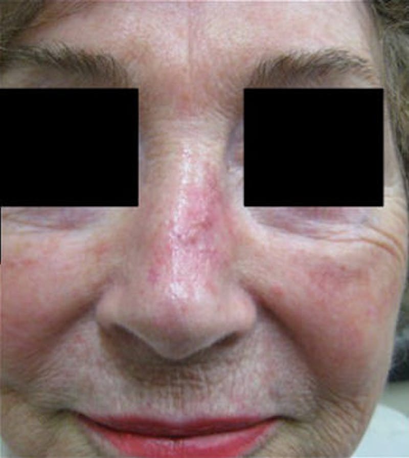 Nasal Reconstruction Before & After Gallery - Patient 272422 - Image 2