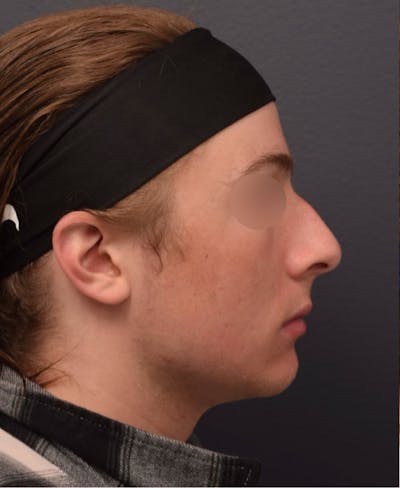 Ultrasonic Rhinoplasty Before & After Gallery - Patient 233793 - Image 1