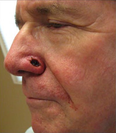 Nasal Reconstruction Before & After Gallery - Patient 171940 - Image 1