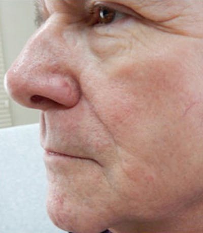 Nasal Reconstruction Before & After Gallery - Patient 171940 - Image 2
