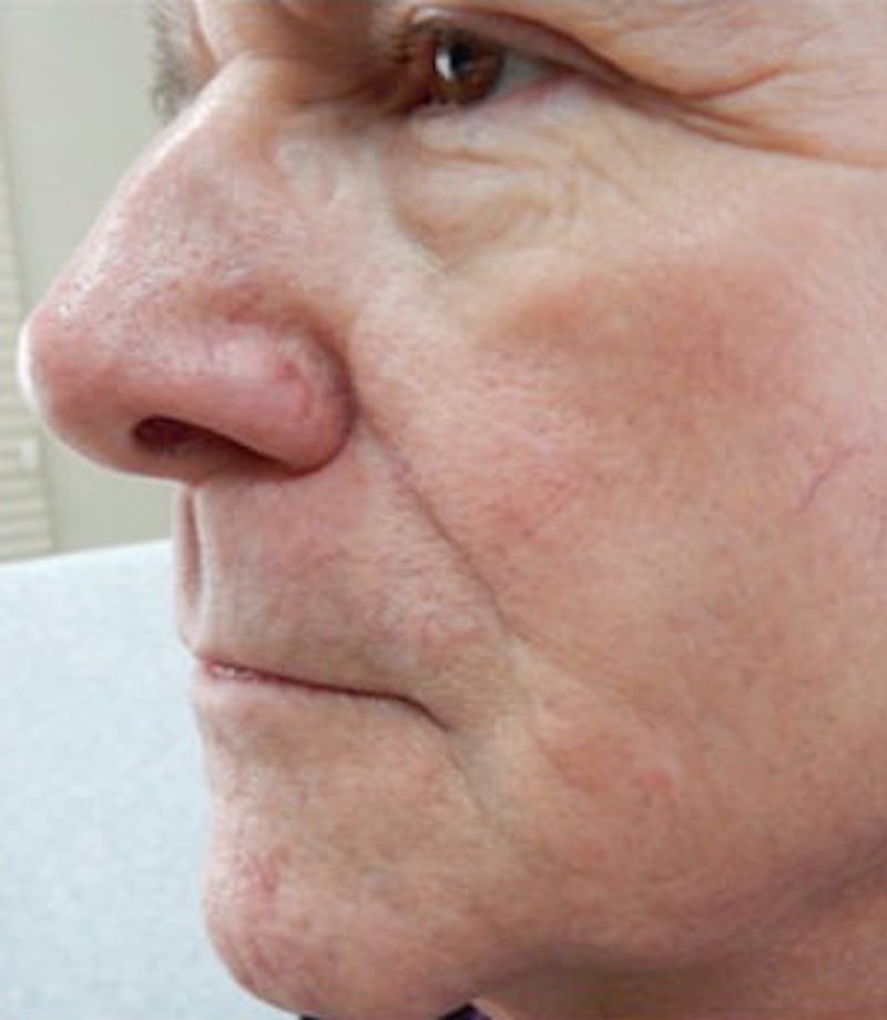 Nasal Reconstruction Before & After Gallery - Patient 171940 - Image 2