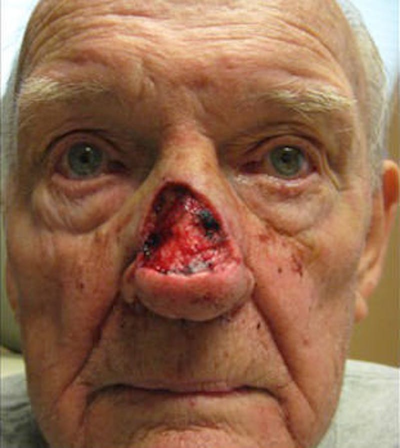 Nasal Reconstruction Before & After Gallery - Patient 326665 - Image 1