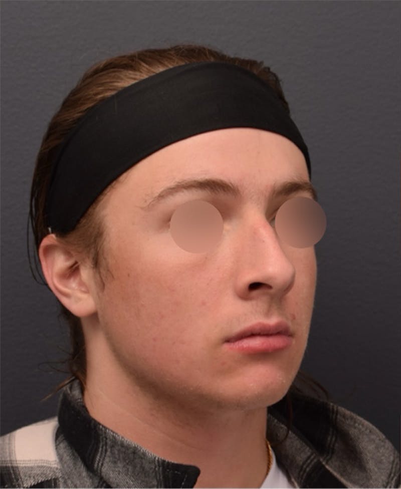 Ultrasonic Rhinoplasty Before & After Gallery - Patient 233793 - Image 5