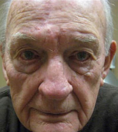 Nasal Reconstruction Before & After Gallery - Patient 326665 - Image 2