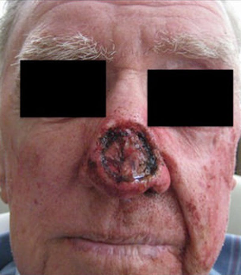 Nasal Reconstruction Before & After Gallery - Patient 792487 - Image 1