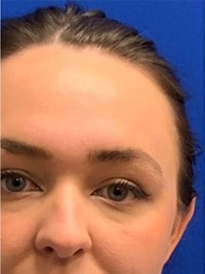 Liquid Rhinoplasty Before & After Gallery - Patient 876092 - Image 1