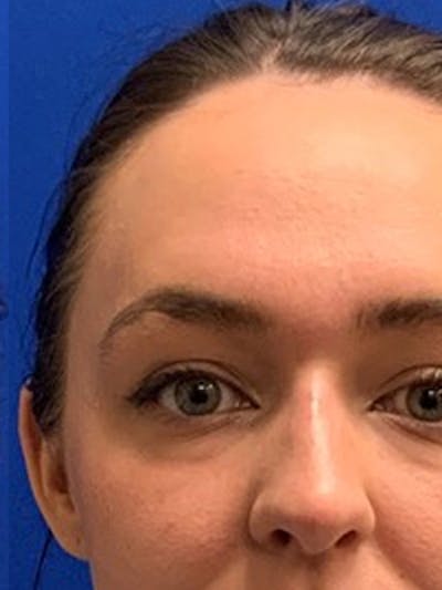 Liquid Rhinoplasty Before & After Gallery - Patient 876092 - Image 2