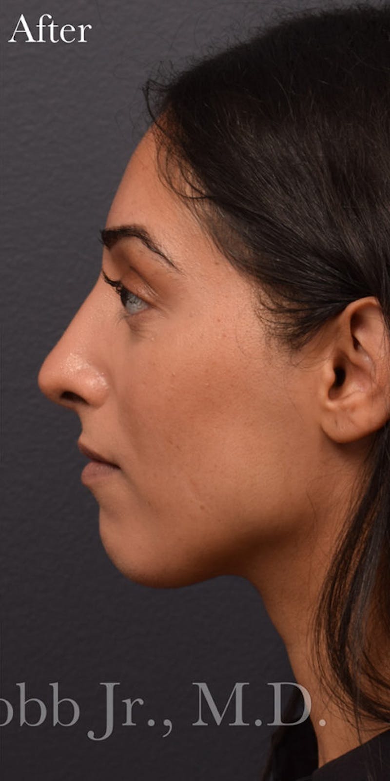 Ultrasonic Rhinoplasty Before & After Gallery - Patient 744703 - Image 2
