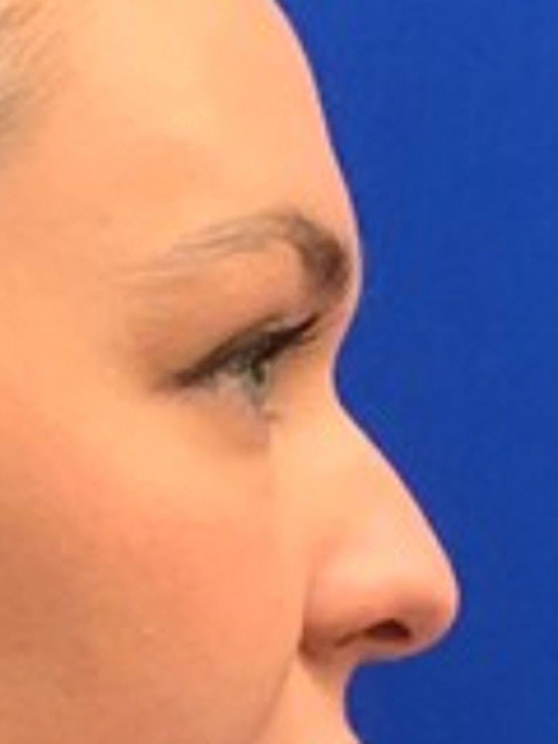 Liquid Rhinoplasty Before & After Gallery - Patient 876092 - Image 5