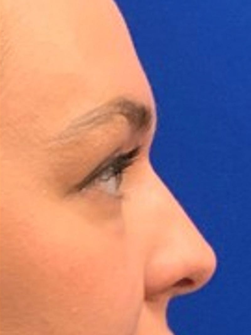 Liquid Rhinoplasty Before & After Gallery - Patient 876092 - Image 6