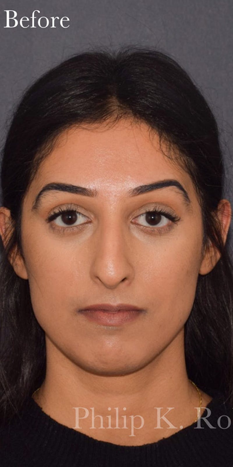 Ultrasonic Rhinoplasty Before & After Gallery - Patient 744703 - Image 3