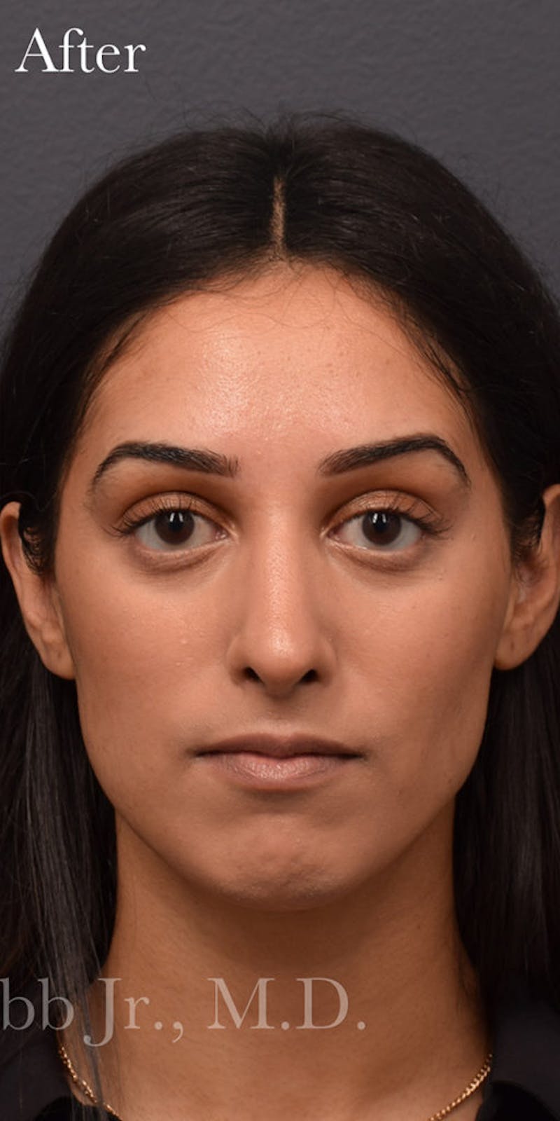Ultrasonic Rhinoplasty Before & After Gallery - Patient 744703 - Image 4