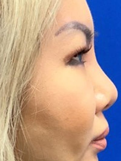 Liquid Rhinoplasty Before & After Gallery - Patient 365601 - Image 1