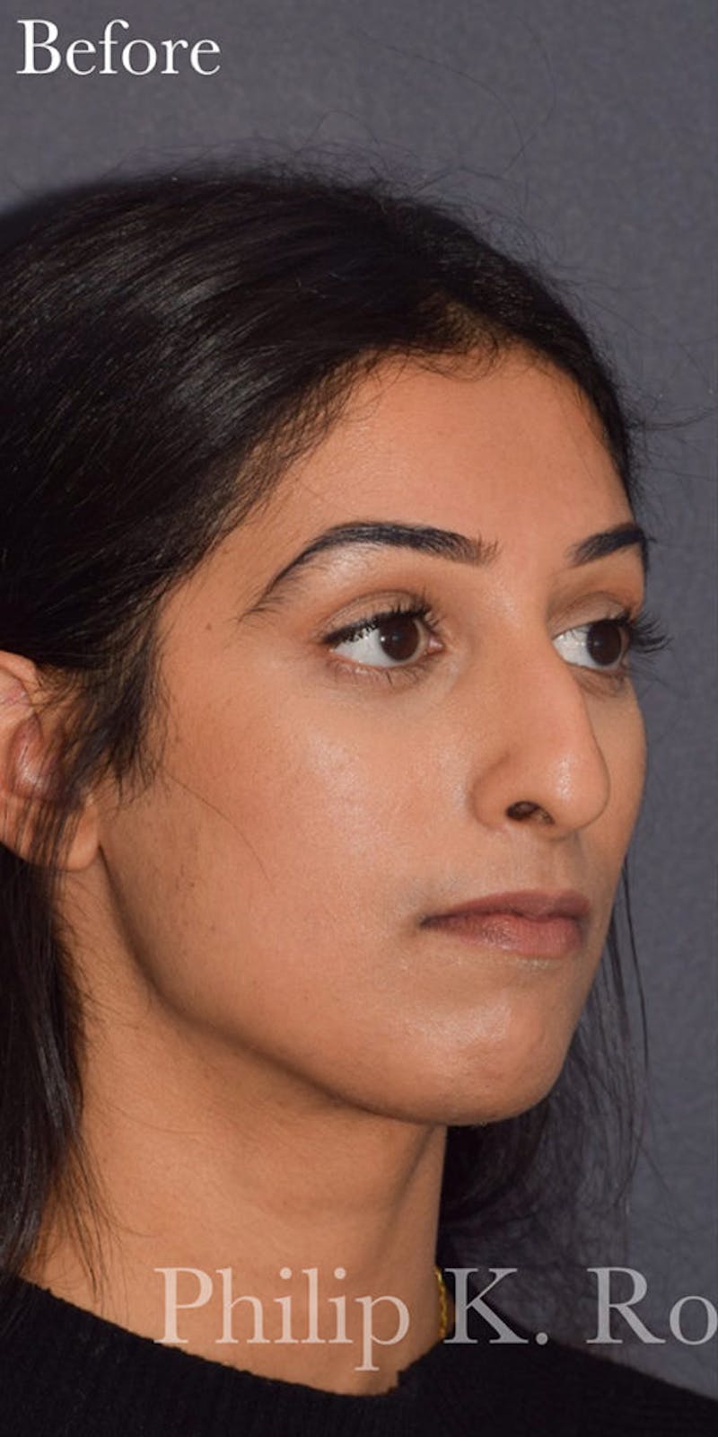Ultrasonic Rhinoplasty Before & After Gallery - Patient 744703 - Image 5