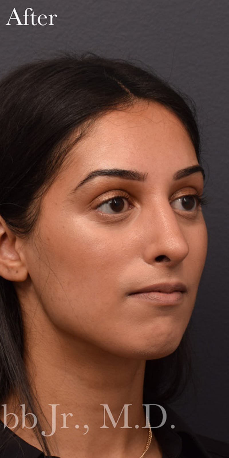 Ultrasonic Rhinoplasty Before & After Gallery - Patient 744703 - Image 6