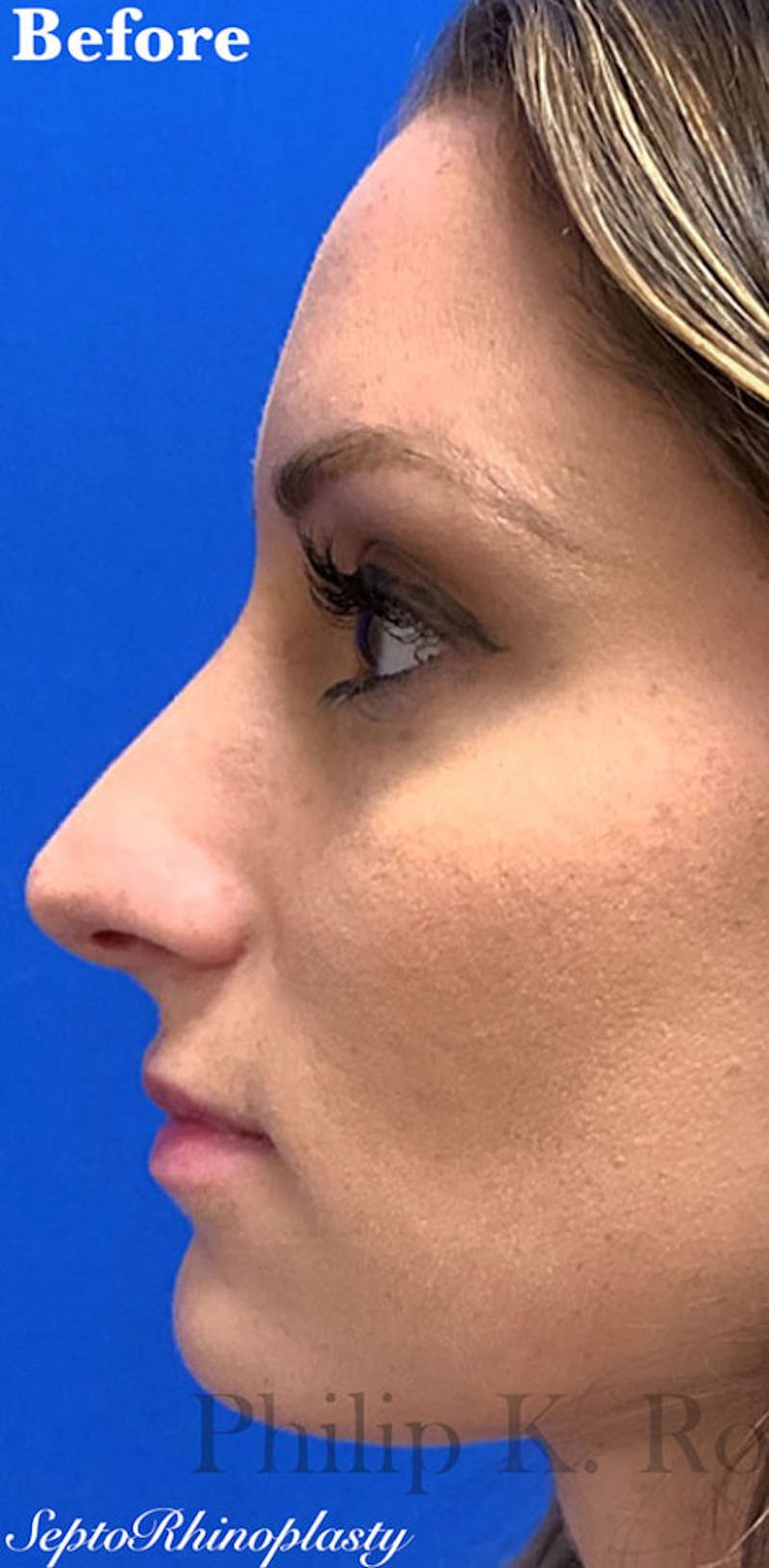 Ultrasonic Rhinoplasty Before & After Gallery - Patient 420626 - Image 1