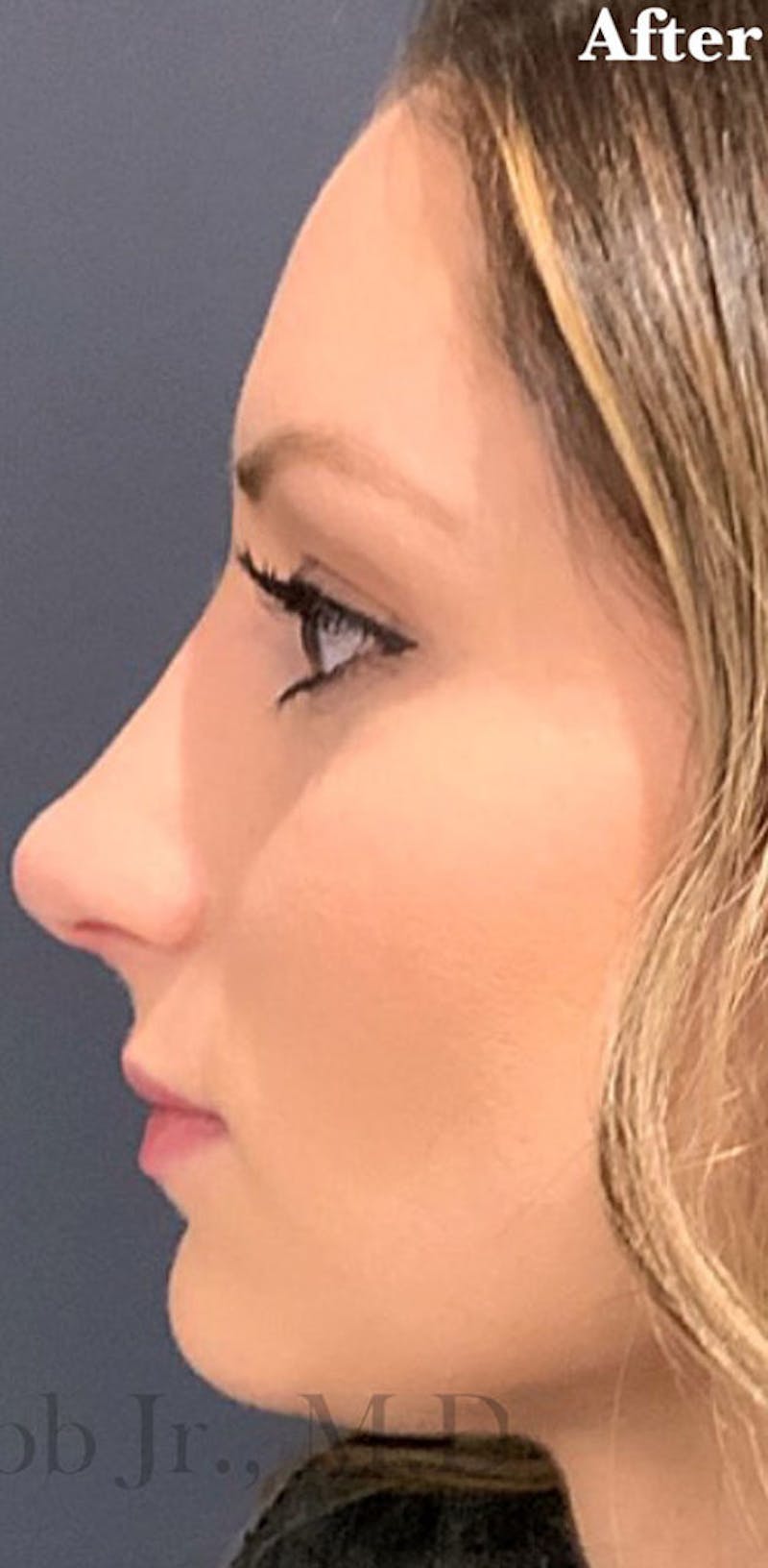 Ultrasonic Rhinoplasty Before & After Gallery - Patient 420626 - Image 2