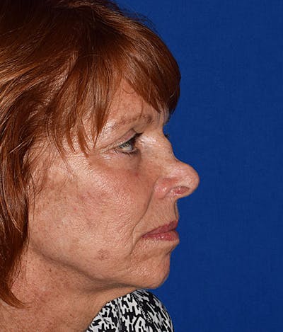 Ultrasonic Rhinoplasty Before & After Gallery - Patient 929536 - Image 1