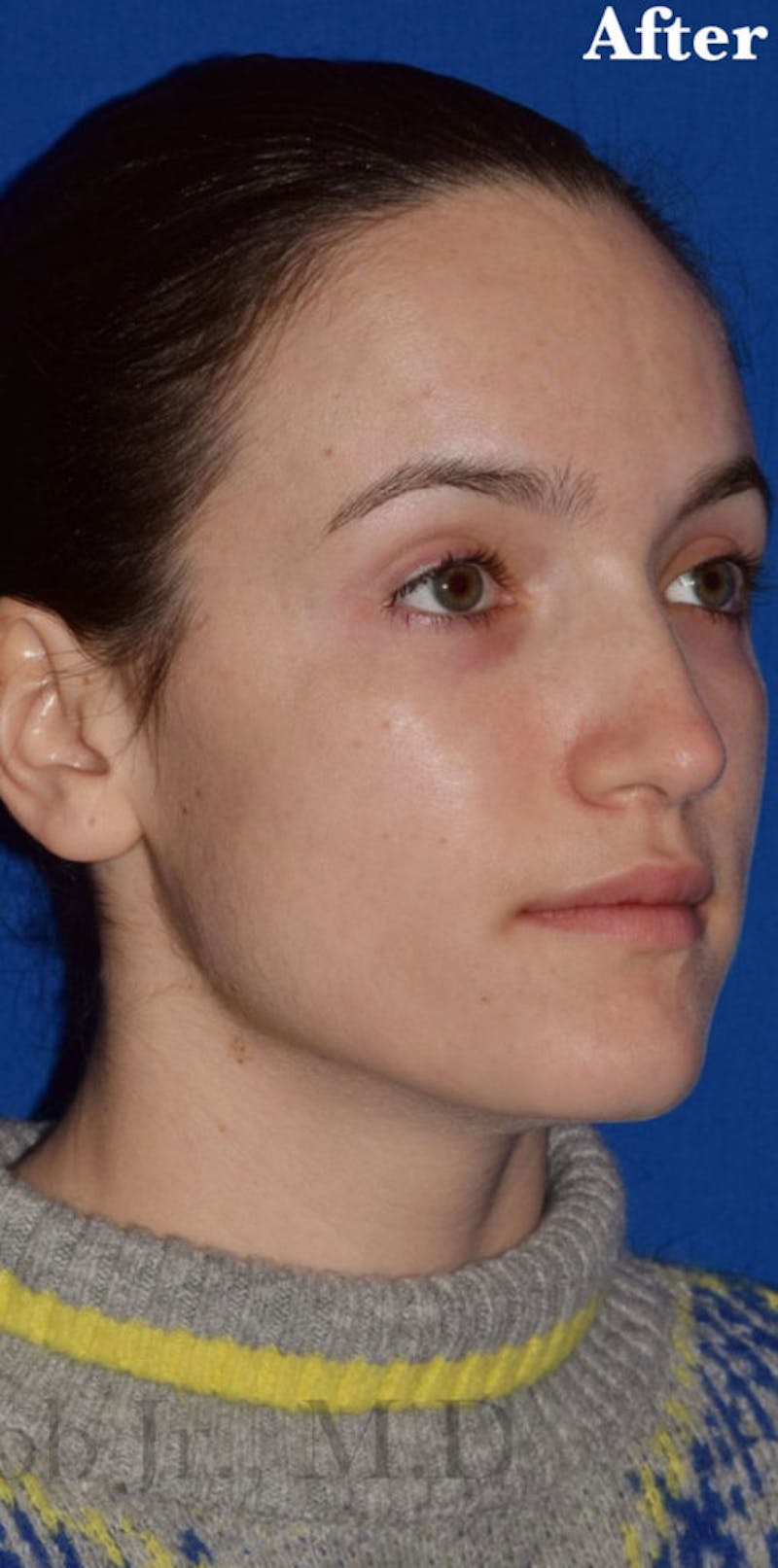Ultrasonic Rhinoplasty Before & After Gallery - Patient 294148 - Image 8