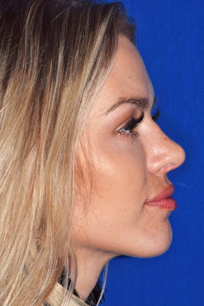 Ultrasonic Rhinoplasty Before & After Gallery - Patient 295949 - Image 2