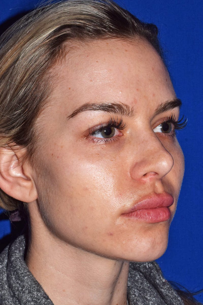 Ultrasonic Rhinoplasty Before & After Gallery - Patient 295949 - Image 3