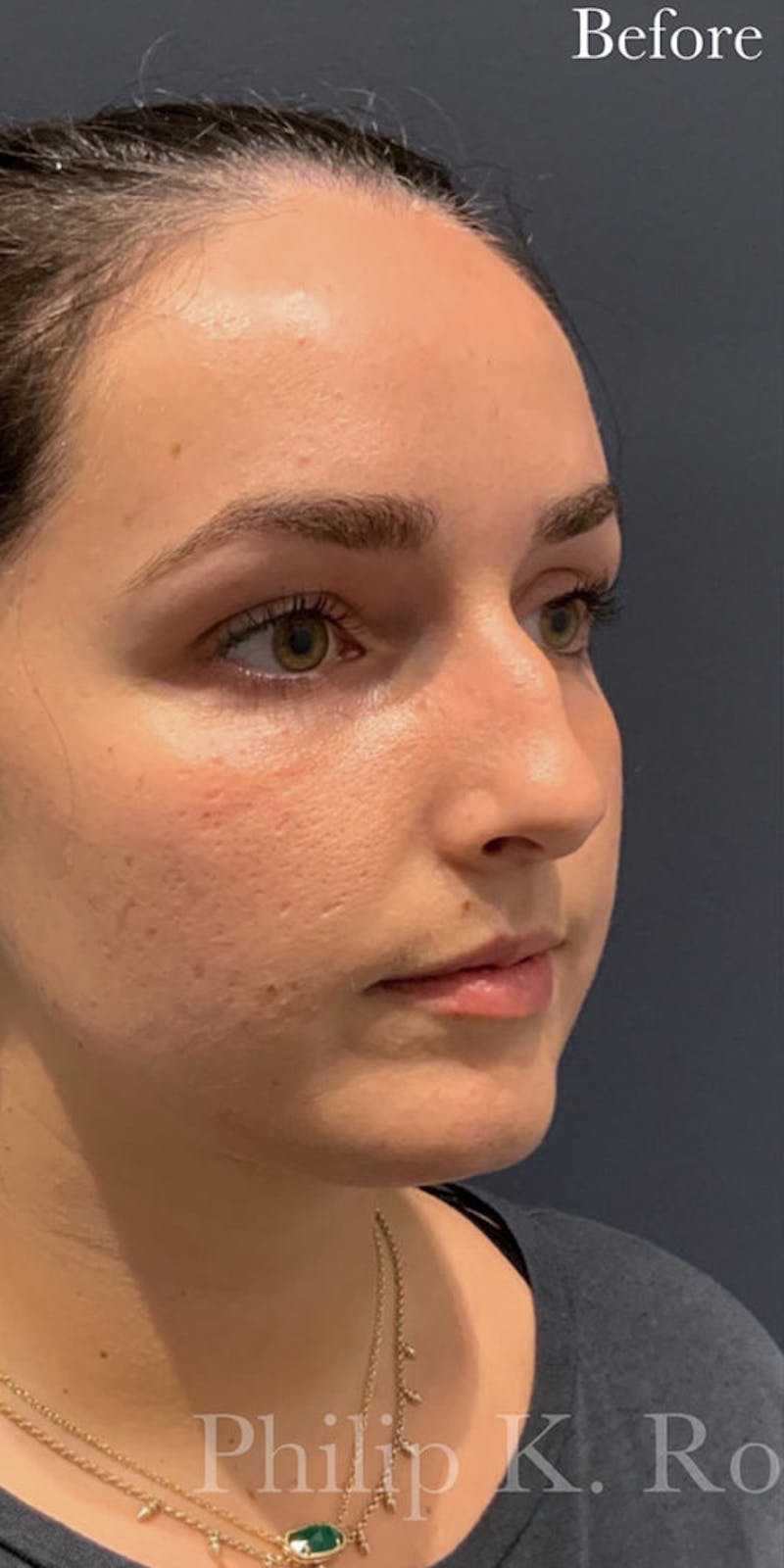 Ultrasonic Rhinoplasty Before & After Gallery - Patient 347688 - Image 1