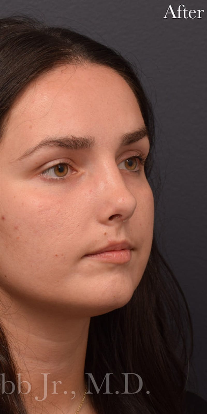 Ultrasonic Rhinoplasty Before & After Gallery - Patient 347688 - Image 2