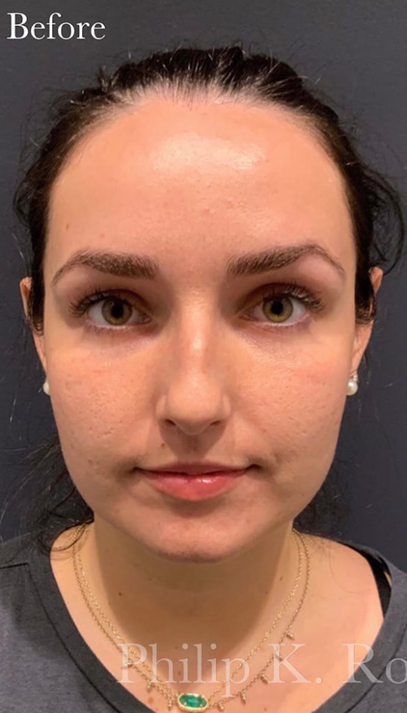 Ultrasonic Rhinoplasty Before & After Gallery - Patient 347688 - Image 3