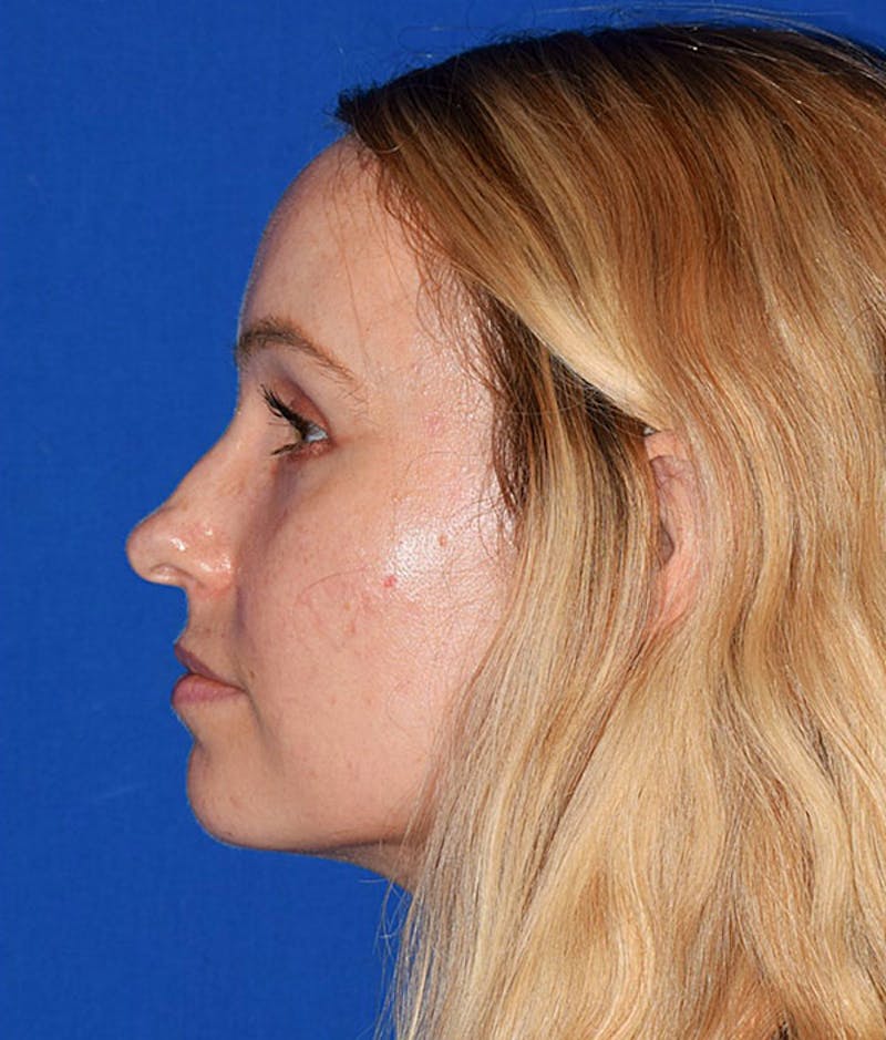 Ultrasonic Rhinoplasty Before & After Gallery - Patient 138750 - Image 1