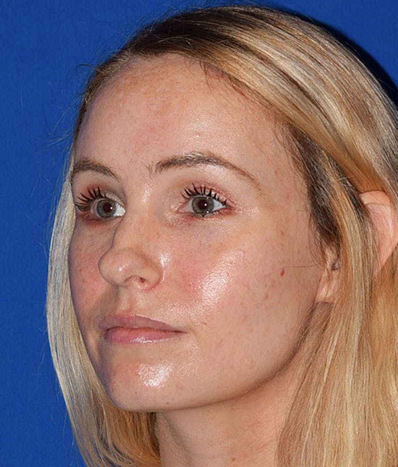 Ultrasonic Rhinoplasty Before & After Gallery - Patient 138750 - Image 3