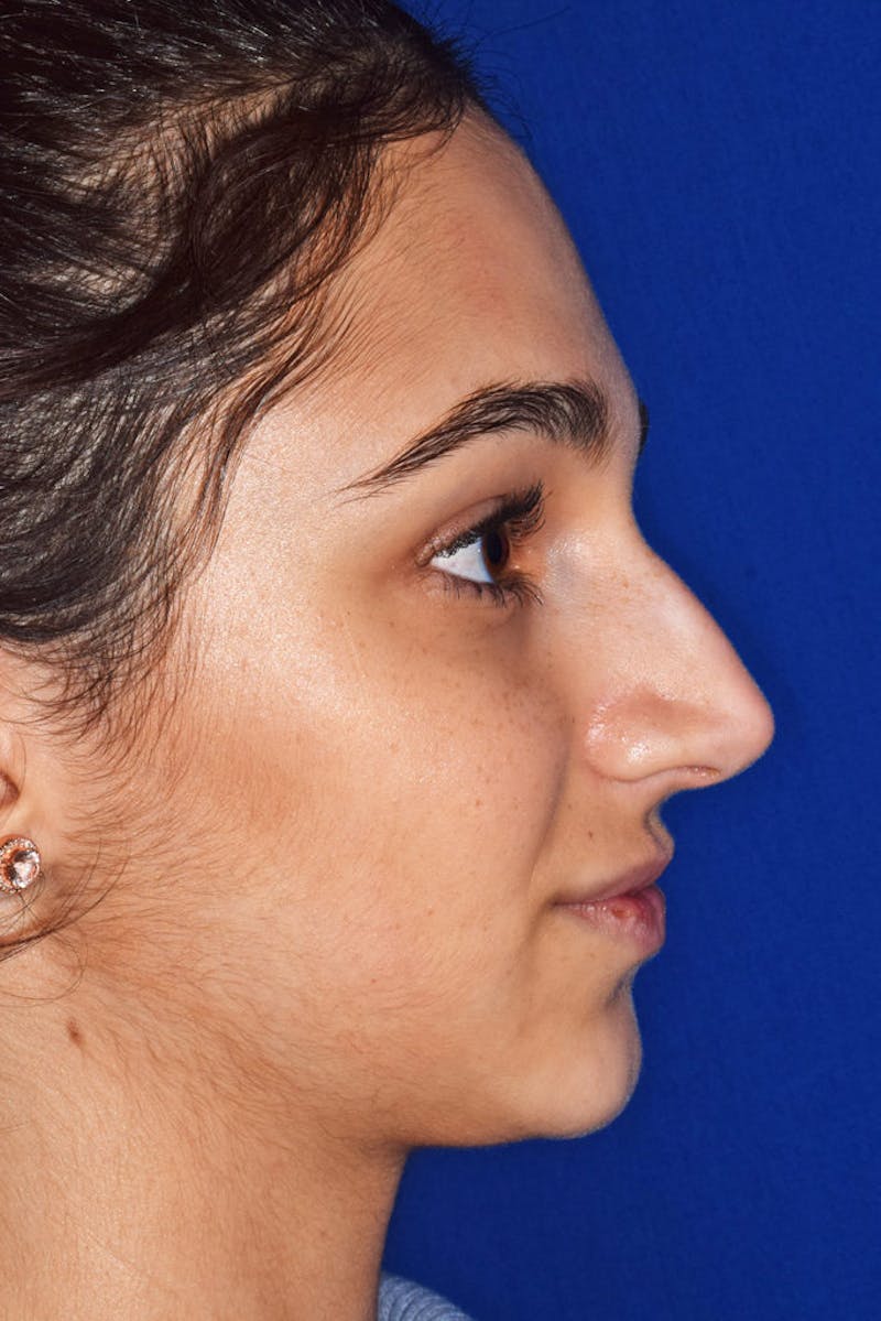 Ultrasonic Rhinoplasty Before & After Gallery - Patient 142086 - Image 1